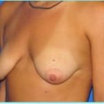 Mastopexy (Breast Lift) Before & After Patient #724