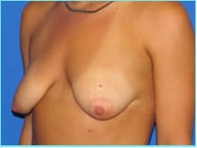 Mastopexy (Breast Lift) Before & After Patient #724