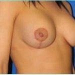 Mastopexy (Breast Lift) Before & After Patient #724