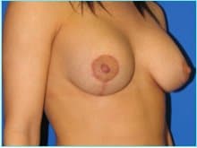 Mastopexy (Breast Lift) Before & After Patient #724