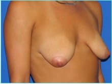 Mastopexy (Breast Lift) Before & After Patient #724
