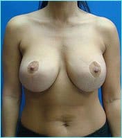Breast Augmentation Revision (Breast Enlargement Repair) Before & After Patient #668