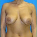 Breast Augmentation Revision (Breast Enlargement Repair) Before & After Patient #668