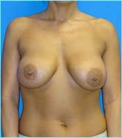 Breast Augmentation Revision (Breast Enlargement Repair) Before & After Patient #668