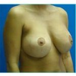 Breast Augmentation Revision (Breast Enlargement Repair) Before & After Patient #668