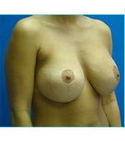Breast Augmentation Revision (Breast Enlargement Repair) Before & After Patient #668