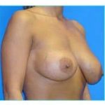 Breast Augmentation Revision (Breast Enlargement Repair) Before & After Patient #668