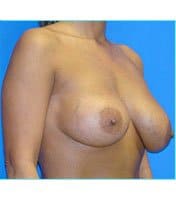 Breast Augmentation Revision (Breast Enlargement Repair) Before & After Patient #668