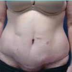 Massive Weight Loss Before & After Patient #1813