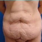 Massive Weight Loss Before & After Patient #1813