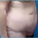 Massive Weight Loss Before & After Patient #1813