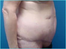 Massive Weight Loss Before & After Patient #1813
