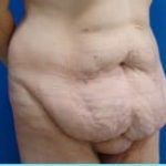 Massive Weight Loss Before & After Patient #1813