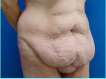 Massive Weight Loss Before & After Patient #1813