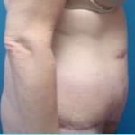 Massive Weight Loss Before & After Patient #1813