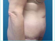 Massive Weight Loss Before & After Patient #1813