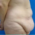 Massive Weight Loss Before & After Patient #1813