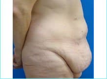 Massive Weight Loss Before & After Patient #1813