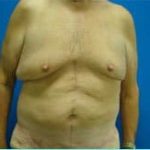 Massive Weight Loss Before & After Patient #1820