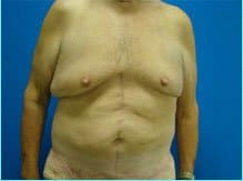 Massive Weight Loss Before & After Patient #1820