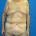 Massive Weight Loss Before & After Patient #1820