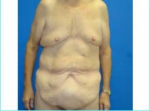 Massive Weight Loss Before & After Patient #1820