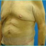 Massive Weight Loss Before & After Patient #1820