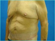 Massive Weight Loss Before & After Patient #1820