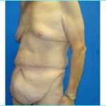 Massive Weight Loss Before & After Patient #1820