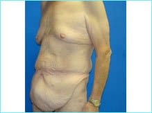 Massive Weight Loss Before & After Patient #1820