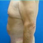 Massive Weight Loss Before & After Patient #1820