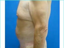 Massive Weight Loss Before & After Patient #1820