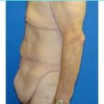 Massive Weight Loss Before & After Patient #1820