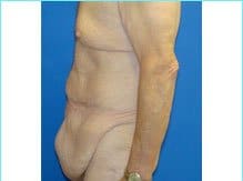 Massive Weight Loss Before & After Patient #1820
