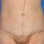 Massive Weight Loss Before & After Patient #1806