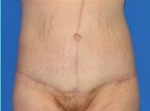Massive Weight Loss Before & After Patient #1806