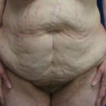 Massive Weight Loss Before & After Patient #1806