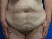 Massive Weight Loss Before & After Patient #1806