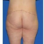 Massive Weight Loss Before & After Patient #1806