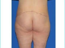 Massive Weight Loss Before & After Patient #1806