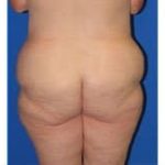 Massive Weight Loss Before & After Patient #1806