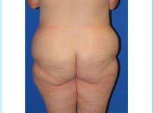 Massive Weight Loss Before & After Patient #1806