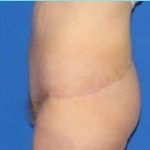 Massive Weight Loss Before & After Patient #1806