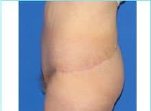 Massive Weight Loss Before & After Patient #1806