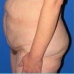 Massive Weight Loss Before & After Patient #1806