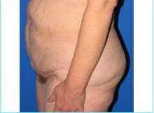 Massive Weight Loss Before & After Patient #1806