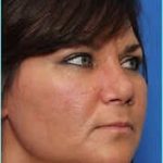 Rhinophyma Before & After Patient #1376