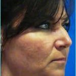 Rhinophyma Before & After Patient #1376