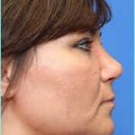 Rhinophyma Before & After Patient #1376