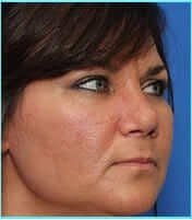 Rhinoplasty Before & After Patient #565